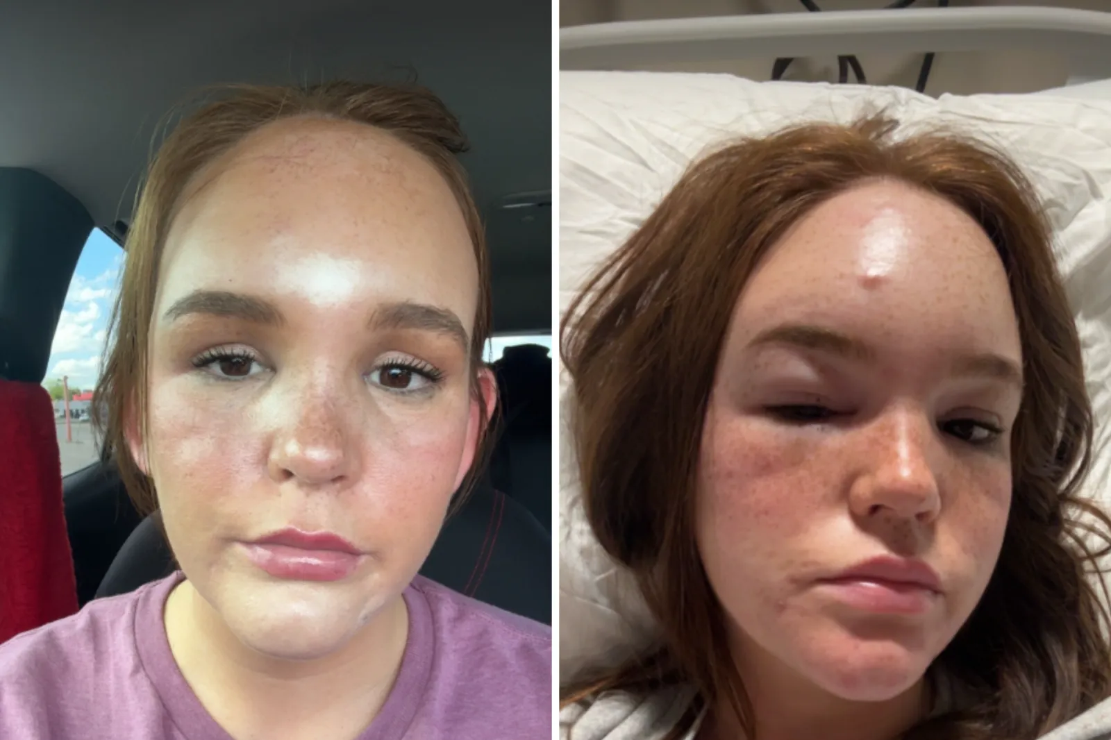 Emma Selvidge in her car on April 2, left, and and in hospital as the swelling increased.