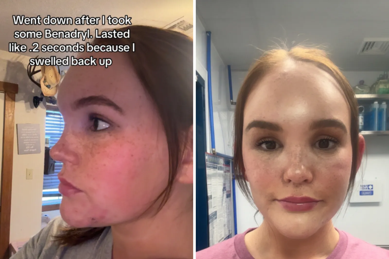 Emma Selvidge on the morning of April 2 with the swelling in her forehead.