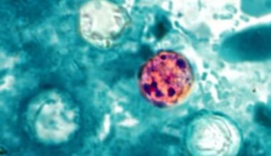 Douglas County confirms 27 local cases of Cyclospora