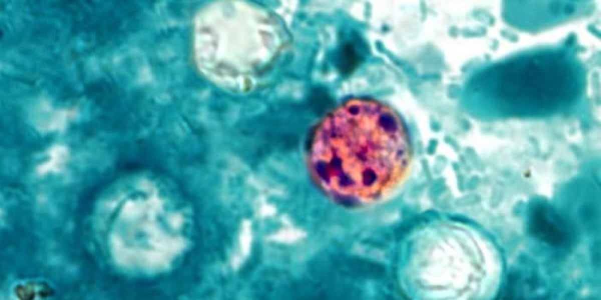 Douglas County confirms 27 local cases of Cyclospora