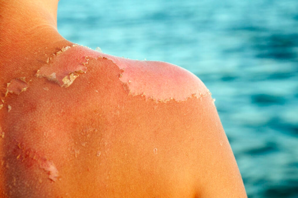 Dermatologists Are Shaking Their Heads at This Injectable Tan Trend