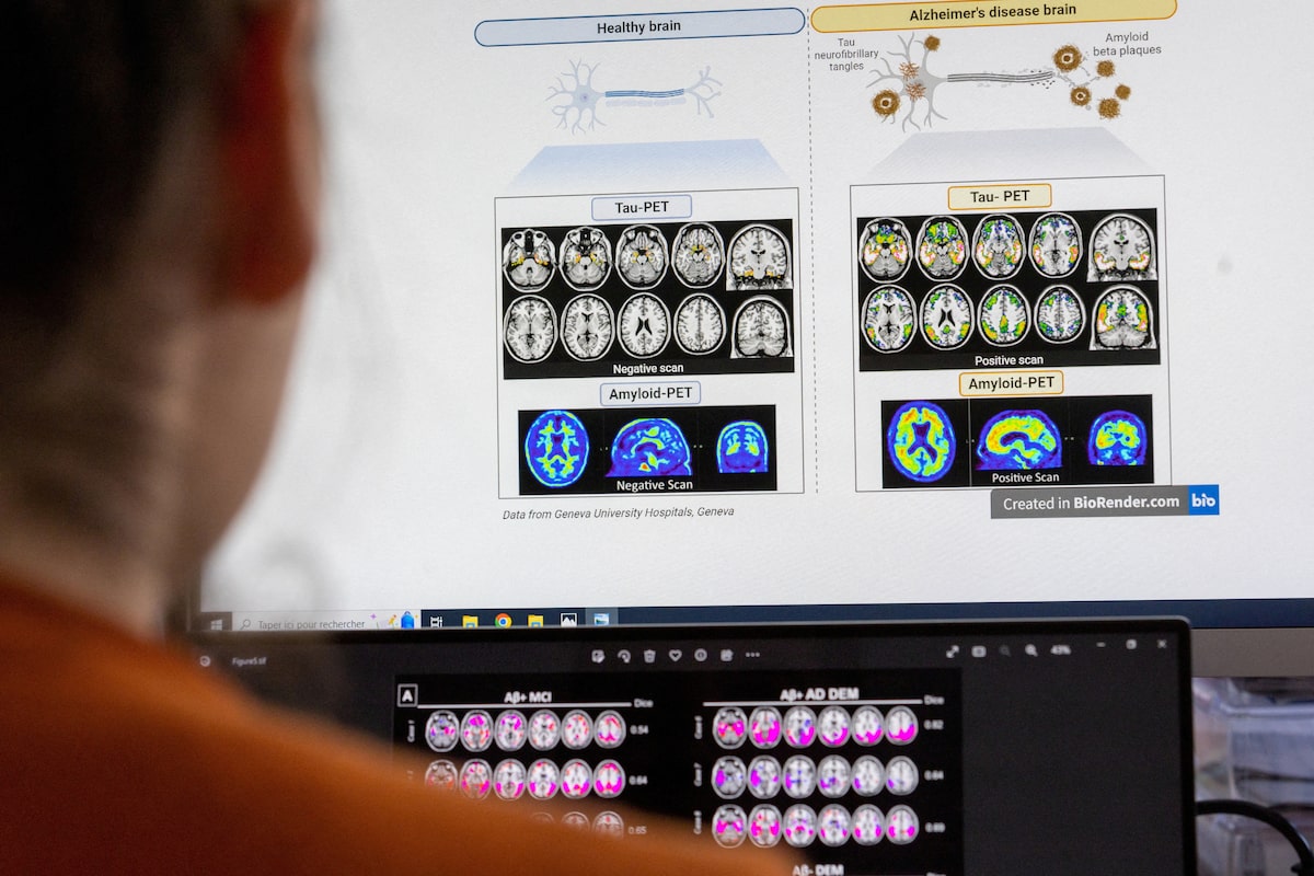 Canada’s Drug Agency reverses course, now recommends public drug plans cover Alzheimer’s drug