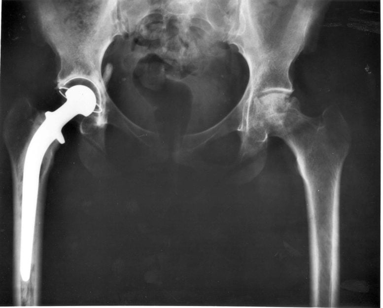 Hip Xray