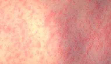 First measles case of year confirmed in Iowa resident, potential exposure locations released