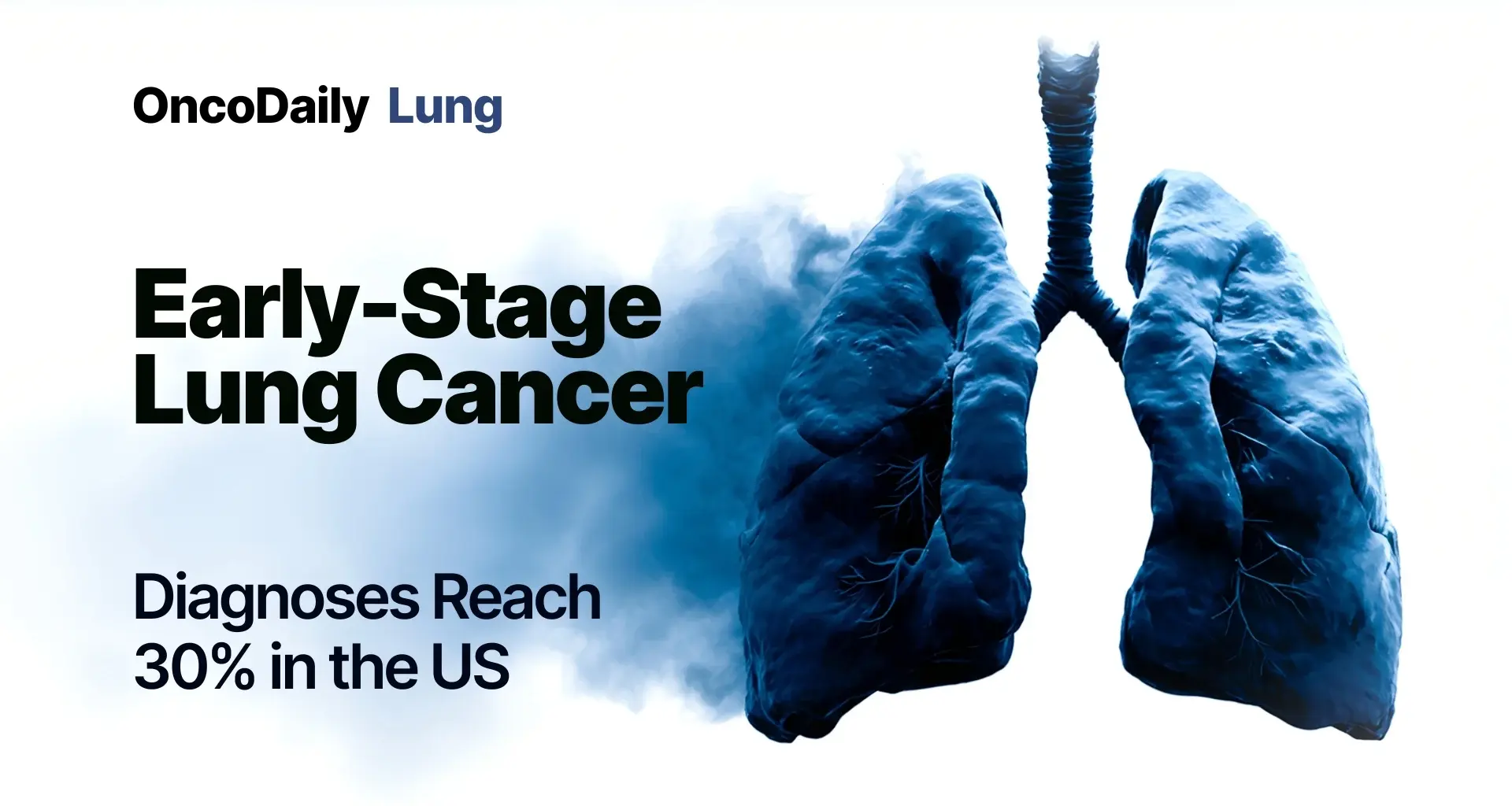 Early-Stage Lung Cancer Diagnoses Rise Across the United States