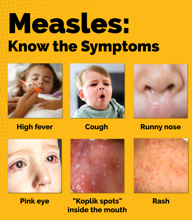 UPDATE: Health Officials Confirm Multiple Measles Cases in St. Mary's County; Possible Exposure at Three Locations Announced - Southern Maryland News Net