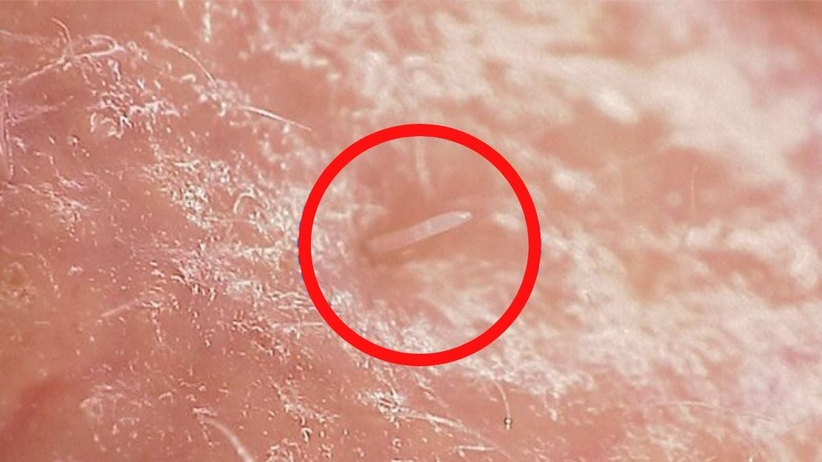 Mites Live on Your Face And, in a Horrifying Turn of Events, They're Starting to Merge With Humans : ScienceAlert