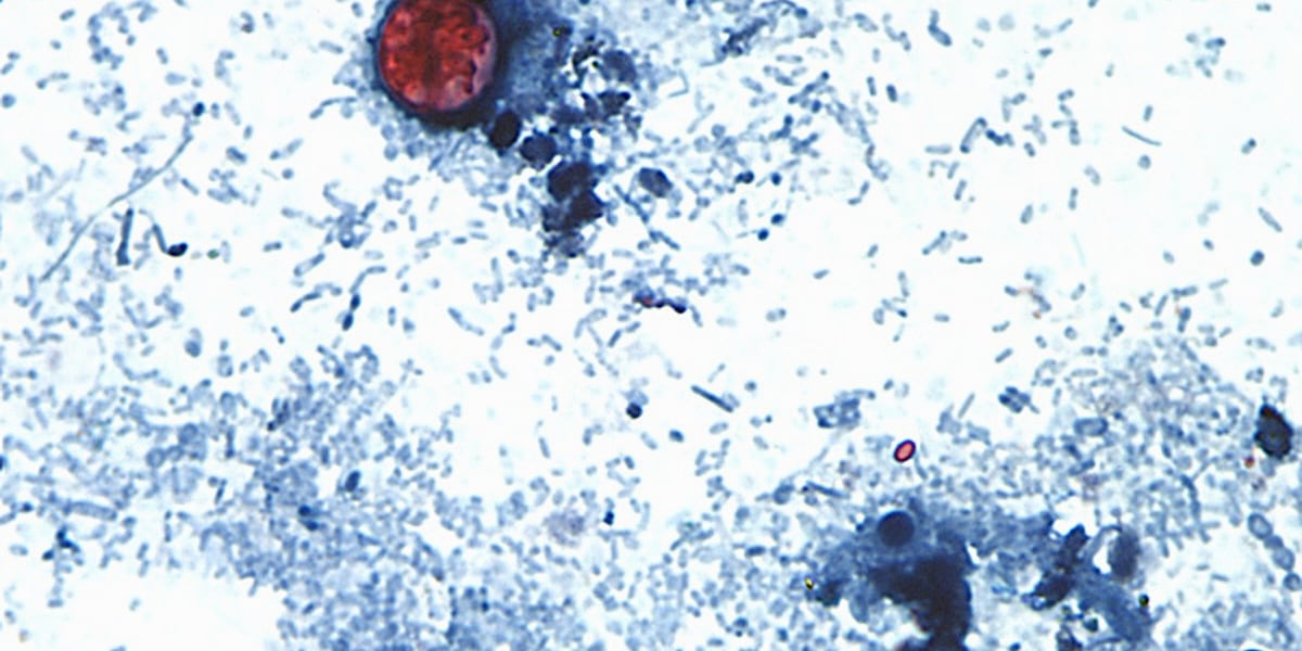 Cases of ‘explosive diarrhea’ in Kansas surge in one week, according to state health data
