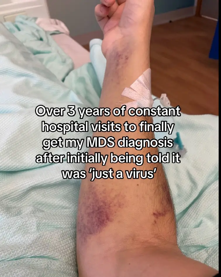 The bruising which Dan experienced (TikTok/@daninprogresss)