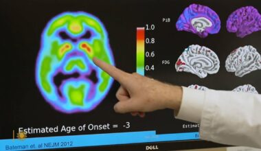 Alzheimer's blood test may predict who's likely to develop symptoms in 5 to 10 years