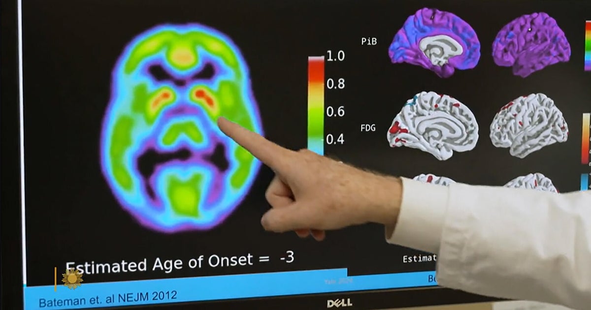 Alzheimer's blood test may predict who's likely to develop symptoms in 5 to 10 years