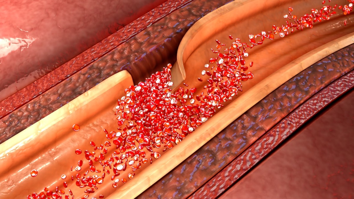 Aortic dissection
