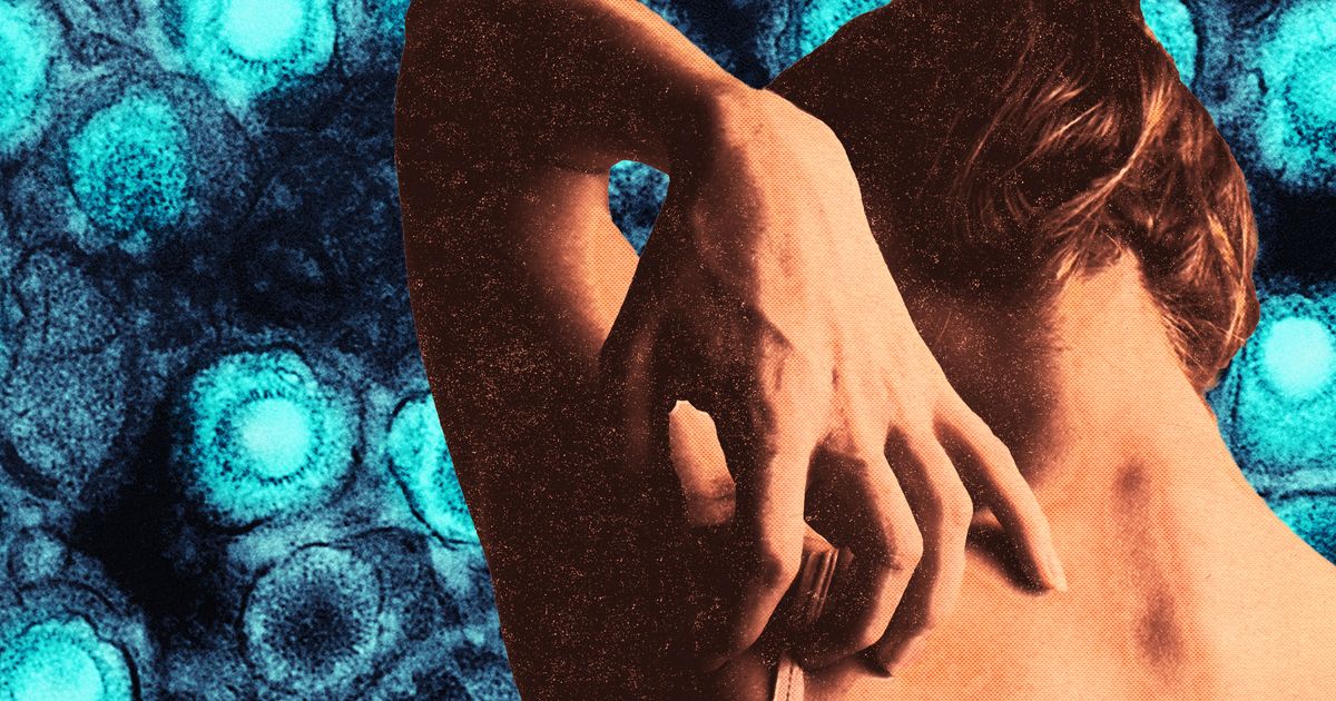 Millennial Women Should Beware Shingles