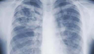 Study suggests the threat of mold-associated illnesses may be underappreciated