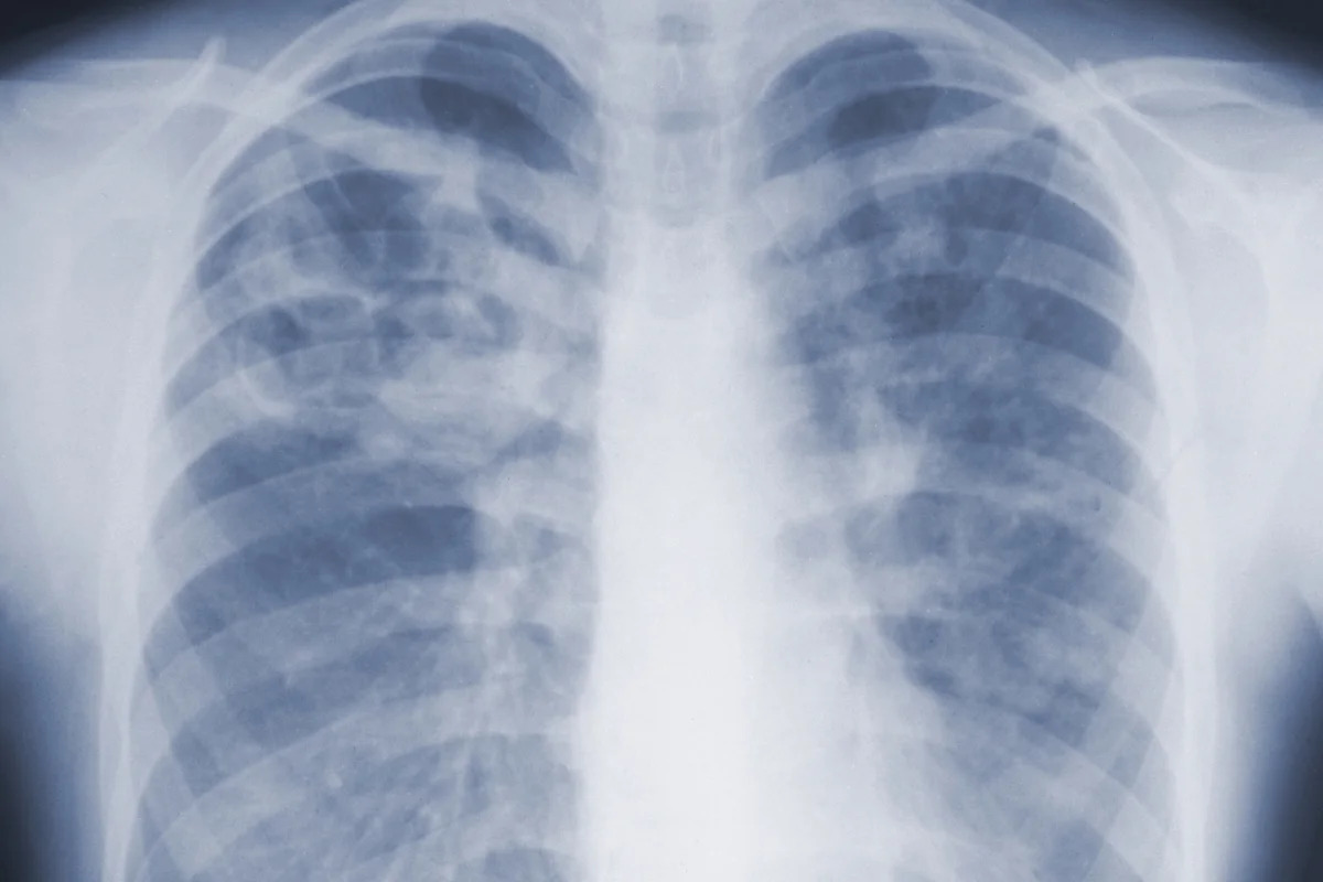 Study suggests the threat of mold-associated illnesses may be underappreciated