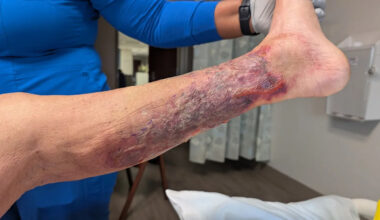 First flesh-eating bacteria death of 2026 recorded in this state