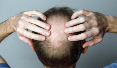Weight loss drugs linked to loss of hair in major new study