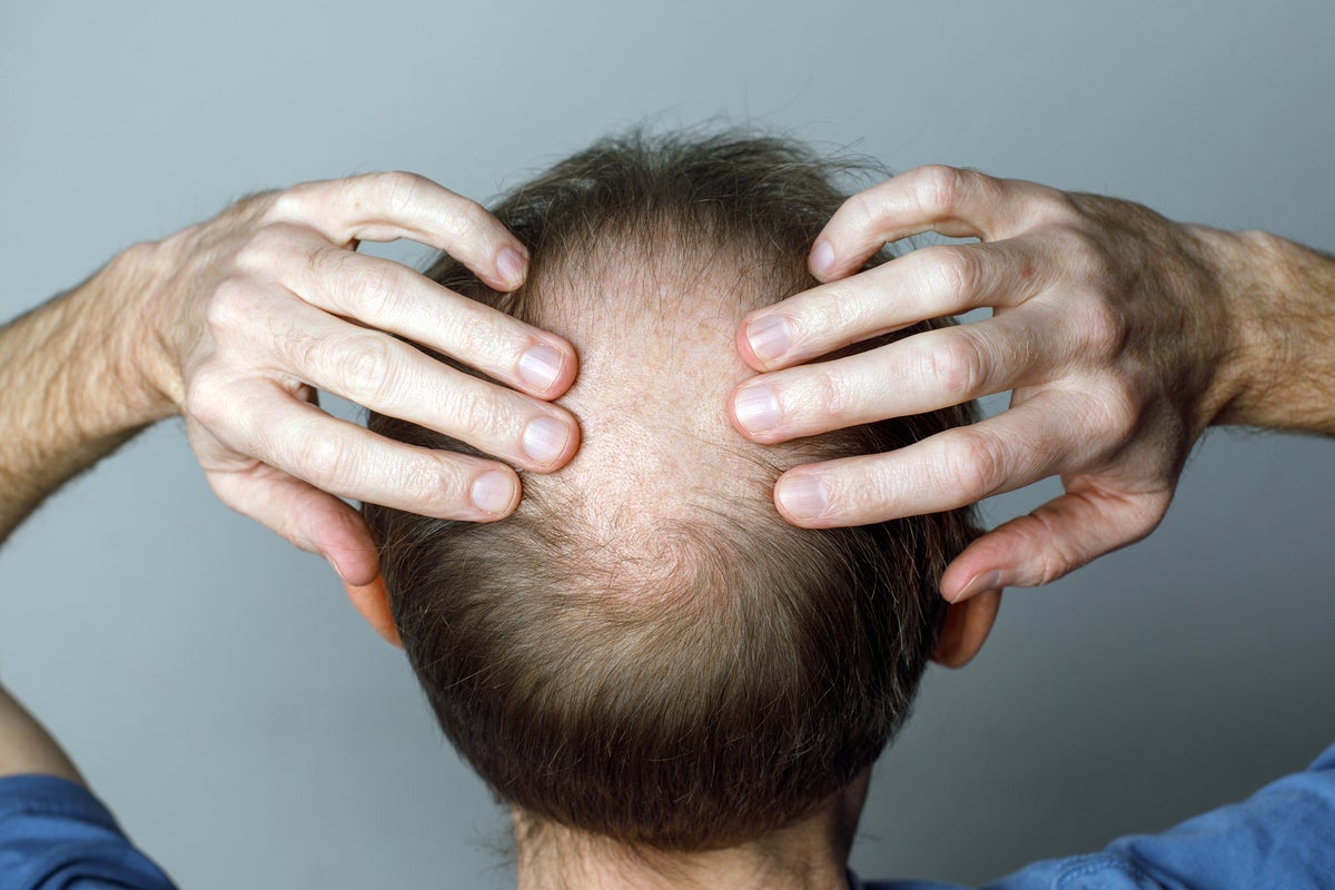 Weight loss drugs linked to loss of hair in major new study