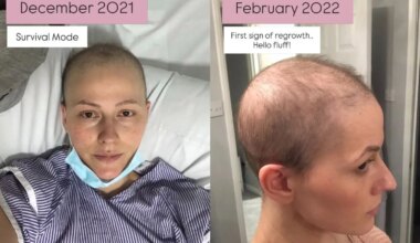 Breast Cancer Survivor Shares What Her Hair Looks Like After Chemotherapy