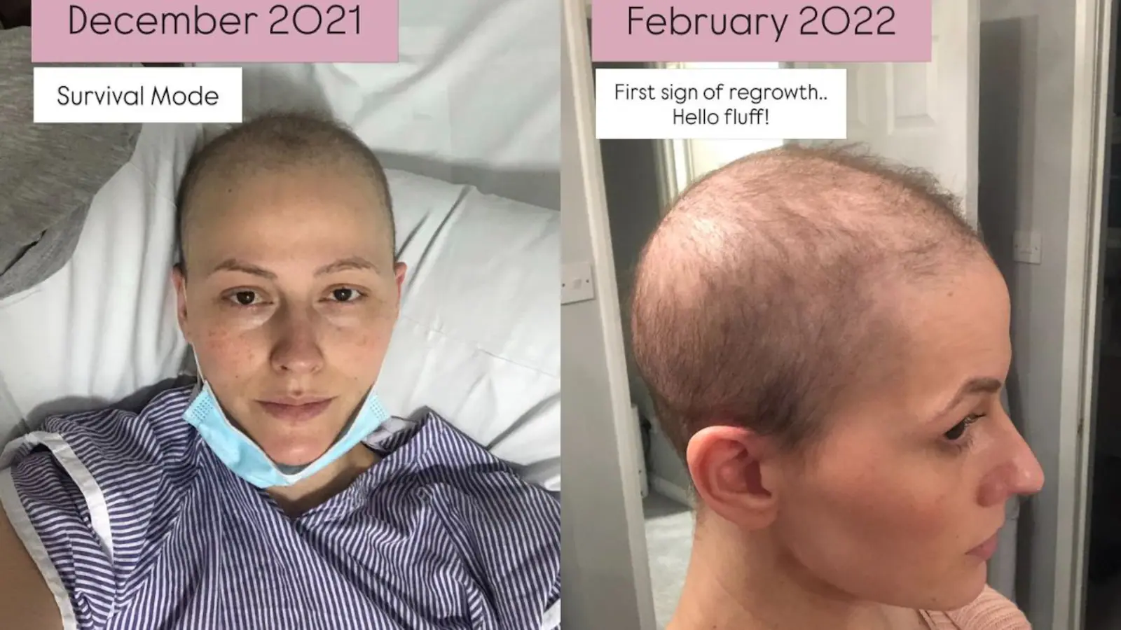 Breast Cancer Survivor Shares What Her Hair Looks Like After Chemotherapy