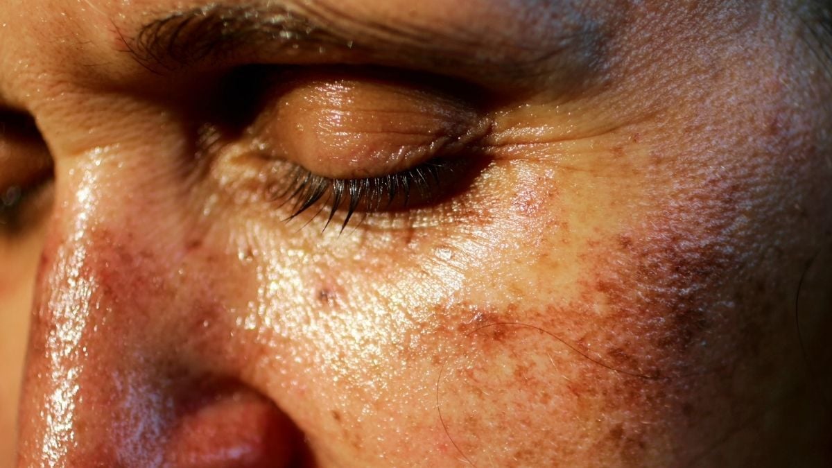 An Illegal Injectable Tanning Drug Is Trending on TikTok – And It May Be Giving People Risky Moles : ScienceAlert