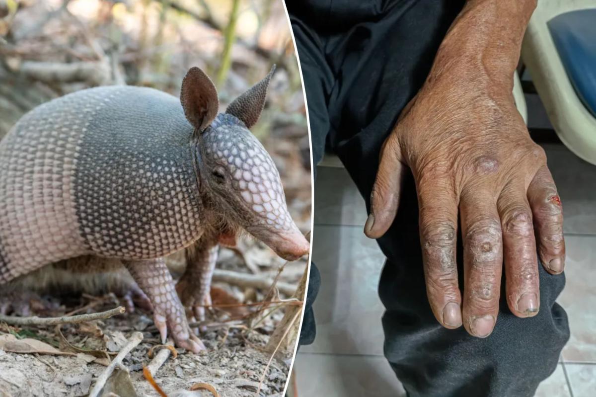 A biblical disease is back with a vengeance in Florida