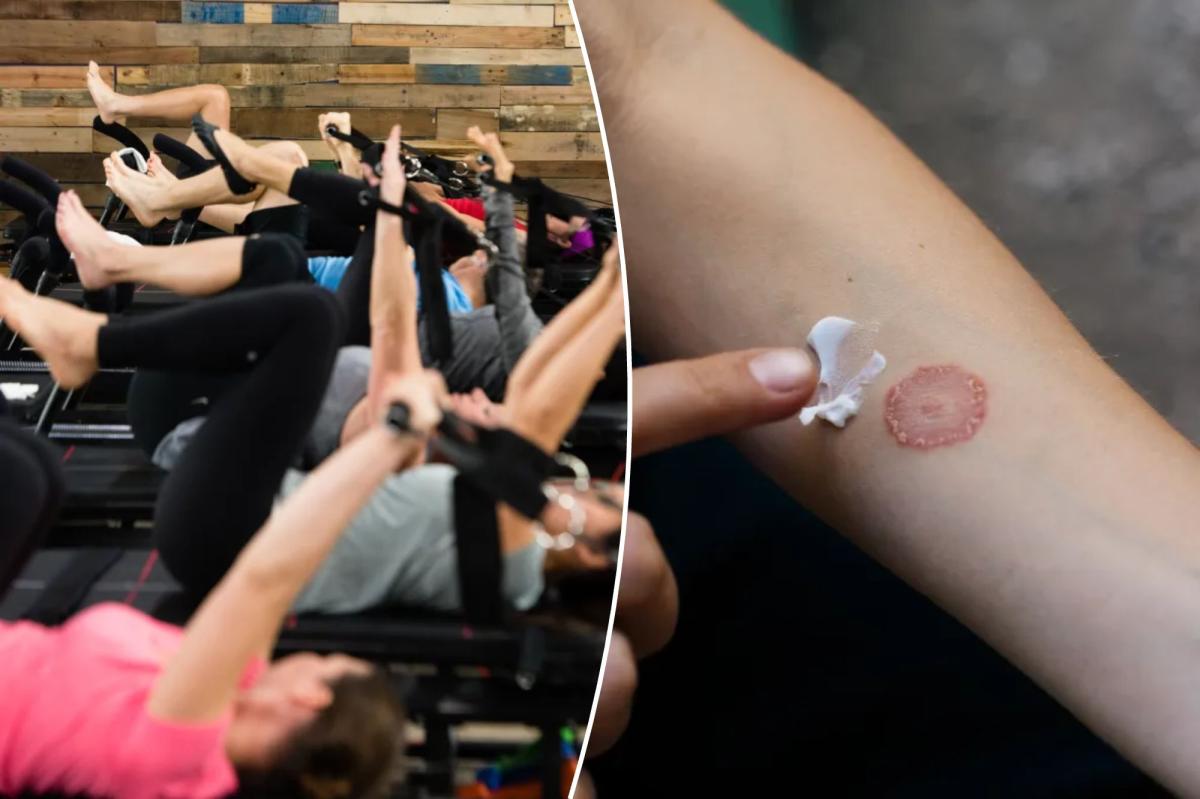 $46-per-class fitness studio is leaving people with ringworm: reports