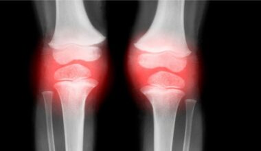 Single Injection Reverses Osteoarthritis in Animals in Just 4 Weeks : ScienceAlert