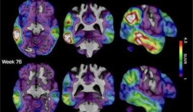 Biogen's experimental Alzheimer's drug targets tau protein