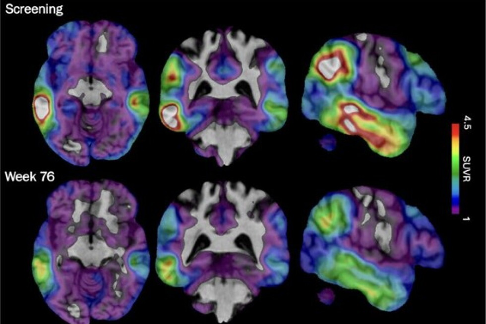 Biogen's experimental Alzheimer's drug targets tau protein