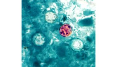 Health Department reports 2 new travel-related cyclosporiasis cases in Hawaii