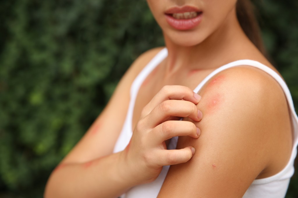 Woman scratching her shoulder with a red insect bite mark.