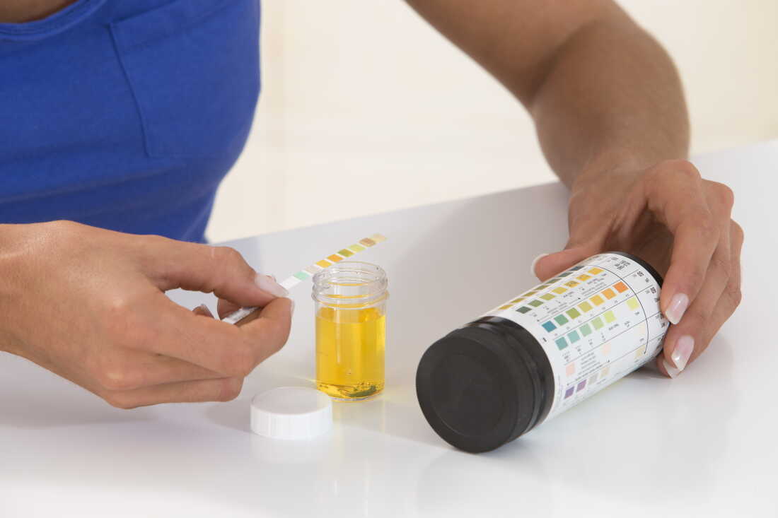 A person using a urine analysis test holds a test strip and compares it to a chart on the bottle.