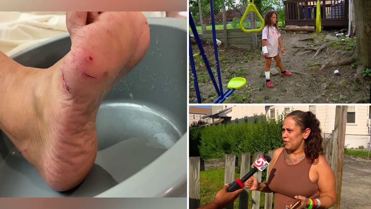 6-year-old girl, woman, bit by fox in Worcester, officials say