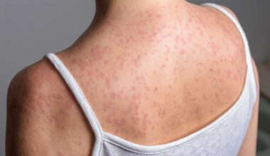 Southern Iowa measles outbreak grows to 12 cases