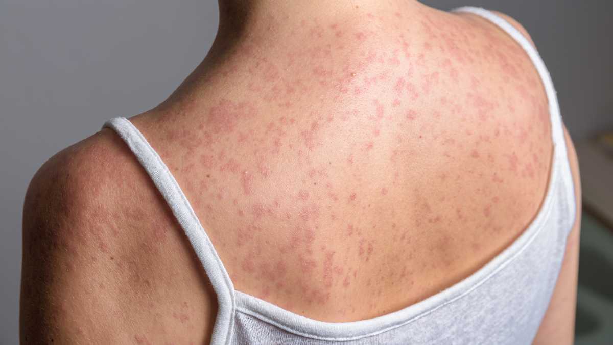 Southern Iowa measles outbreak grows to 12 cases