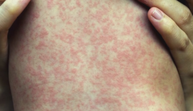 Outbreak of Measles confirmed in Kentucky; officials report hospitalizations