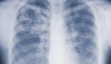 Years after he quit smoking, a lung cancer scan saved his life