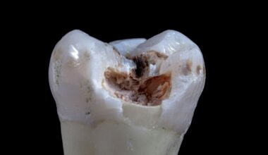 A 10-Second Treatment Can Stop Tooth Decay in Kids Without Drilling : ScienceAlert