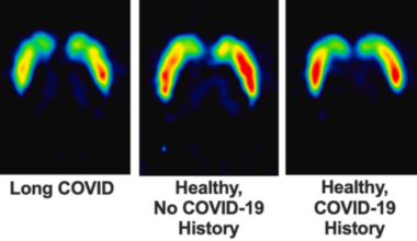 Long COVID Patients Have 18% Fewer Dopamine Nerve Endings, Brain Scans Reveal : ScienceAlert