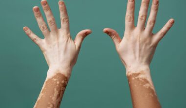 UAE approves new use of drug to treat vitiligo