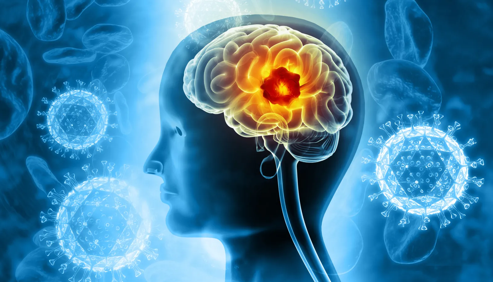 An illustration of a brain tumor or cancer.