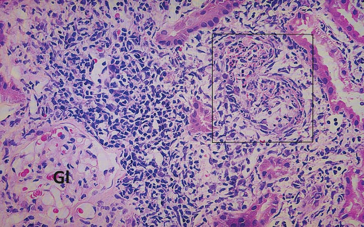 Kidney tissue from a sugarcane cutter with CKDu.