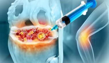 Knee Joint Injection Platelet Rich Plasma Osteoarthritis