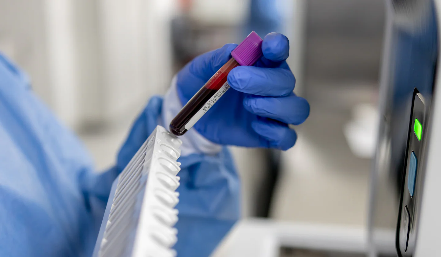 What men need to know about PSA screening for prostate cancer