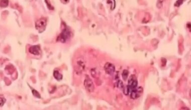 45 measles cases confirmed in Ohio in 2026
