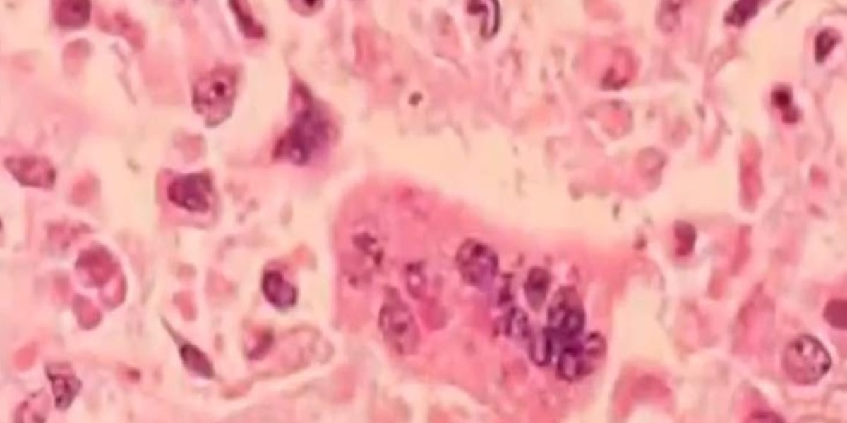 45 measles cases confirmed in Ohio in 2026