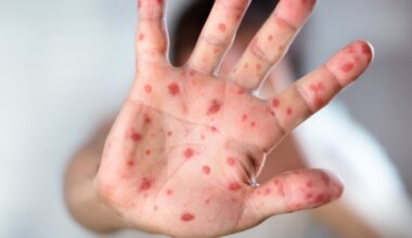 Connecticut confirms third measles case of 2026, highest since 2019