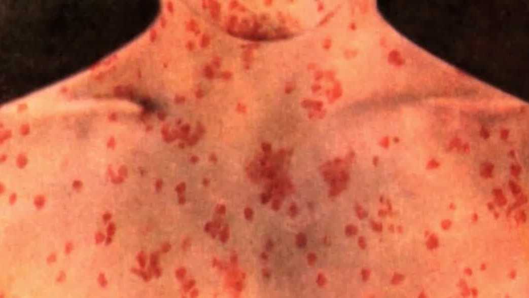 Measles in Iowa: Sunnyside Grocery in Bloomfield named potential exposure location