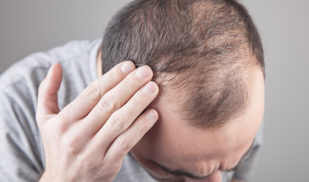 A man with receding dark hair touches his scalp, concerned about hair loss.